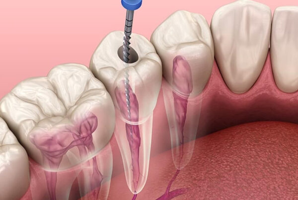 Kanal Tedavisi / Endodonti