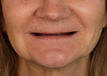 patient-one-before